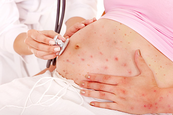 chicken pox in pregnancy