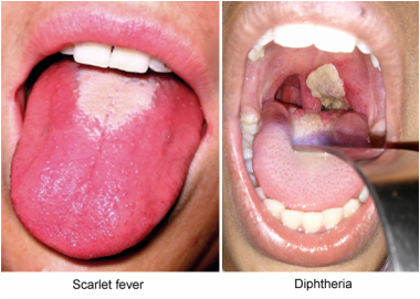 scarlet fever or diphtheria