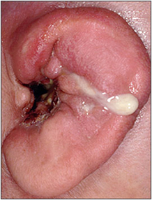 Malignant otitis with pus from necrotic bone in the auditory canal