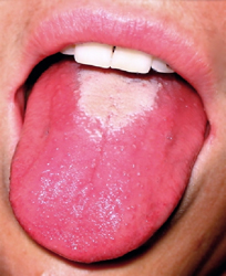 scarlet fever strawberry tongue