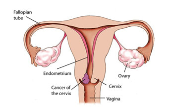Cervical cancer screening