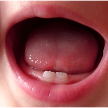 Doxycycline and deciduous teeth