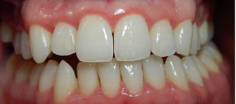 Dental infections Gingivitis 