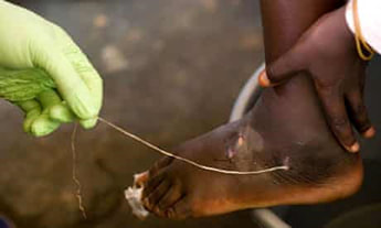 Guinea worm