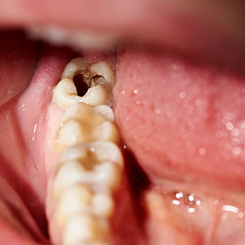 Dental infection dental caries